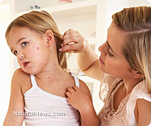 Child-Measles-Chicken-Pox-Sick